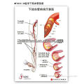 Wholesalec 3D Medical Chart---Lower extremity vascular disease
